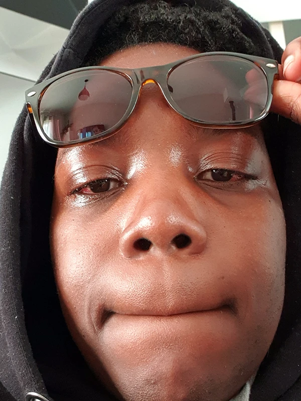 Yeux de Christelle 2 jours après l'opération du strabisme