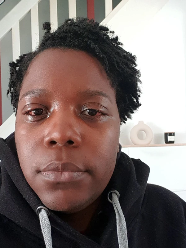 Évolution des yeux de Christelle à J+4