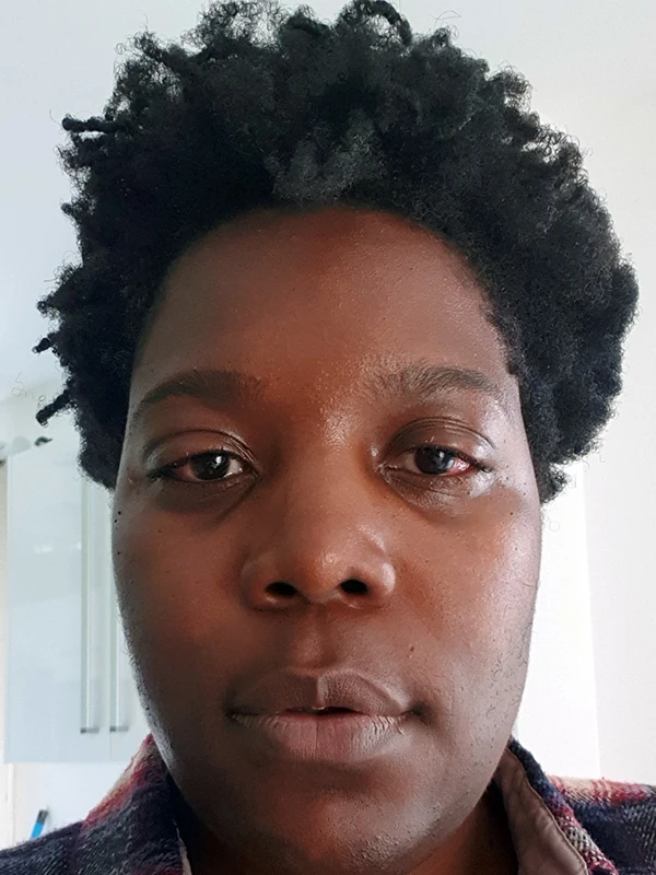 Évolution des yeux de Christelle à J+7
